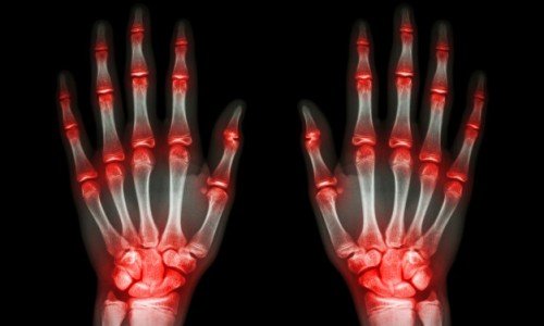 Продукти, които намаляват болката в ставите