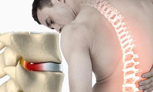 Протрузия или дискова херния – къде е разликата?