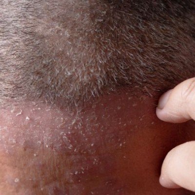 Какво трябва да знаем за шампоаните за псориазис?