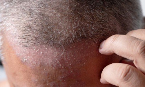 Какво трябва да знаем за шампоаните за псориазис?