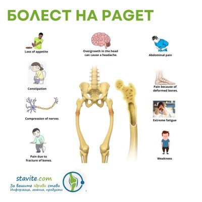 Болест на Paget: Разберете повече за този проблем за здравето на ставите