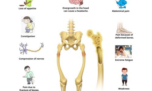 Болест на Paget: Разберете повече за този проблем за здравето на ставите