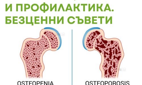 Остеопения: Симптоми, лечение и профилактика. Безценни съвети