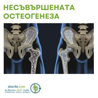 Победете несъвършената остеогенеза: Помощникът за ставите, които всички трябва да знаем