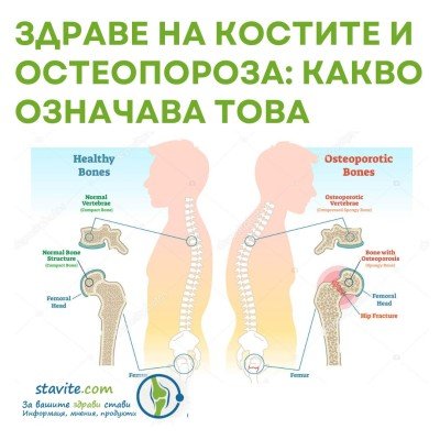 Здраве на костите и остеопороза: Какво означава това за вас